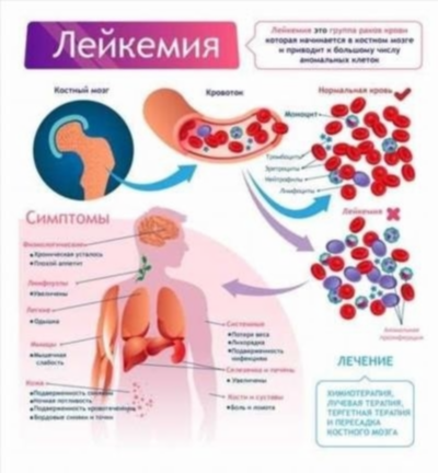 Лечение и профилактика лейкоза: как предотвратить и остановить заболевание