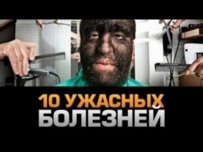 Обезьяний герпес В: летальность – до 70%