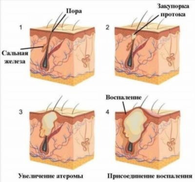 Причины возникновения атеромы