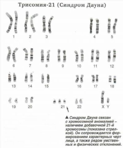 Миф №1: Ребёнок с синдромом Дауна рождается только у женщин старшего возраста