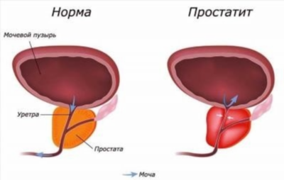 Распространенное заблуждение №2: простатит – только проблема старше 40 лет