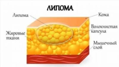 Характеристика и виды липомы