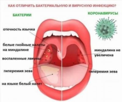 Клиническая картина при паратонзиллярном абсцессе