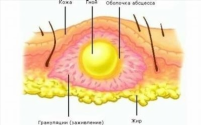 Осложнения ягодичного абсцесса