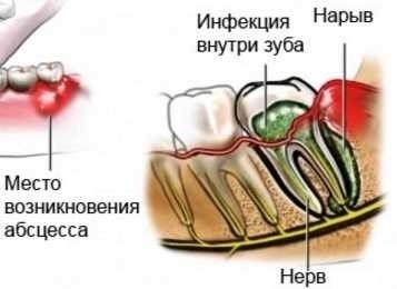 Диагностика пародонтального абсцесса