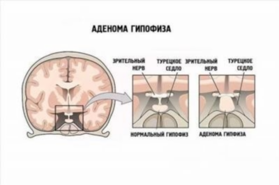 Аденома гипофиза - причины, симптомы, диагностика и лечение [название сайта]