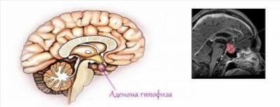 Виды аденомы гипофиза