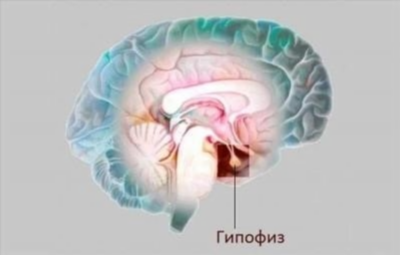 Причины аденомы гипофиза