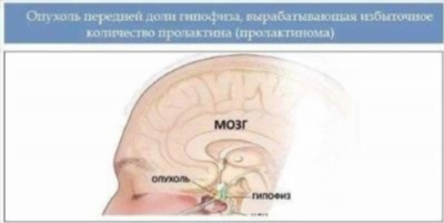 Что такое аденома гипофиза головного мозга