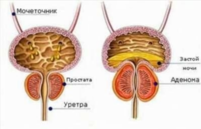 Аденома простаты у мужчин - симптомы и лечение