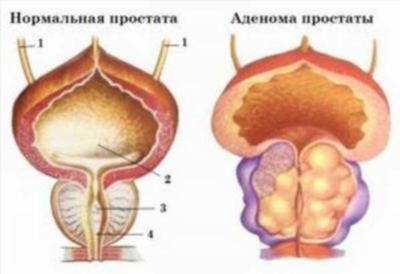 Диагностика аденомы простаты