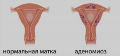 Какие бывают формы аденомиоза?