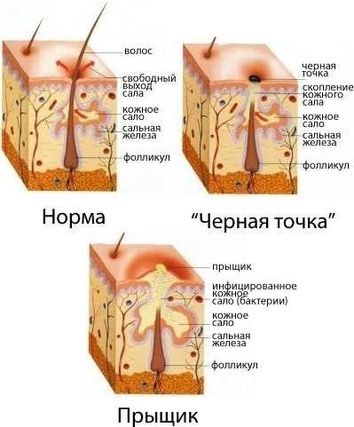 Профилактика акне у взрослых