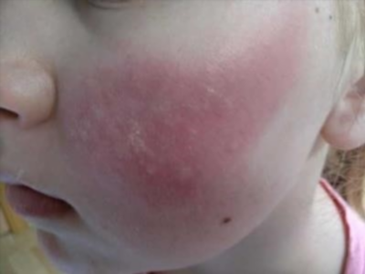 Аллергическая реакция на солнечные лучи у ребенка