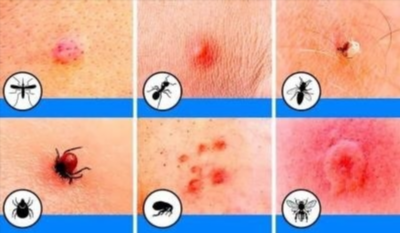 Лечение аллергической реакции на укусы насекомых