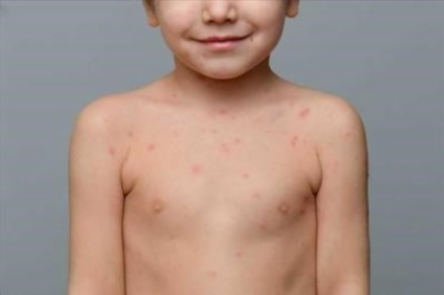 Высыпания на коже у ребенка при аллергии: как выглядит сыпь и как ее лечить
