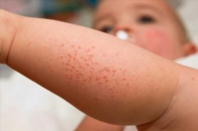 Фото аллергического дерматита у детей
