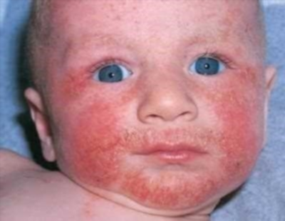 Аллергический дерматит у детей – фото, симптомы, причины