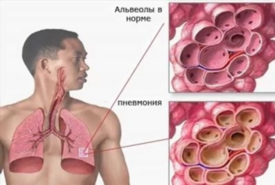 Как отличить аллергию от простуды