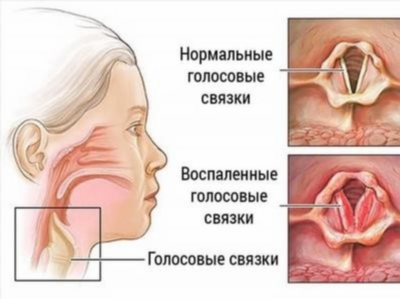 Аллергическая бронхиальная астма