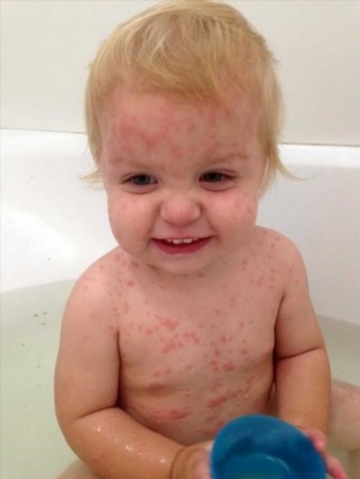 Аллергический кашель у ребенка: симптомы и лечение