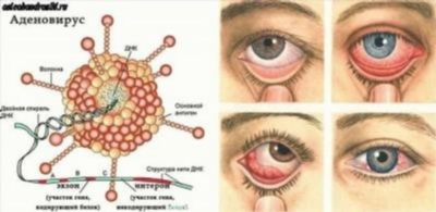 Лечение аллергического конъюнктивита