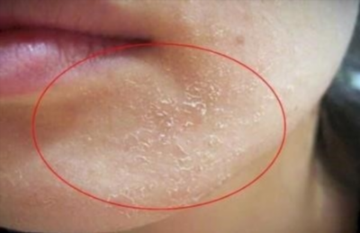 Как предотвратить появление аллергии на лице и красных пятен?