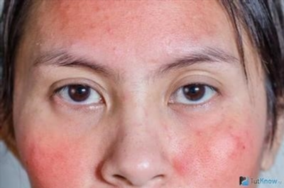 Средства от аллергии на коже лица и красных пятен
