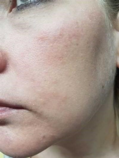 Основные причины аллергии на лице и красных пятен