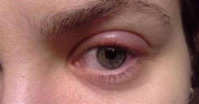 Аллергия на глазах: симптомы, причины и лечение у взрослых