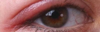 Аллергия на глазах у ребенка: симптомы