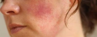 Аллергия и Энтеросгель: эффективное средство