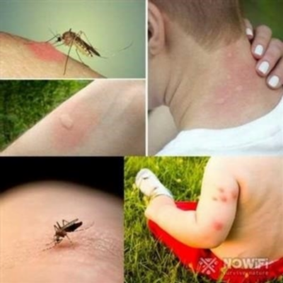 Причины аллергии на комариный укус у ребенка