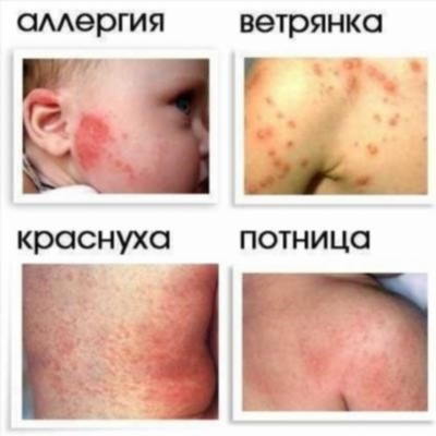 Аллергия у детей до трех лет
