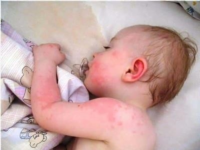 Основные симптомы аллергии на смесь у грудного ребенка