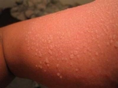 Чем и как лечить аллергию на солнце?