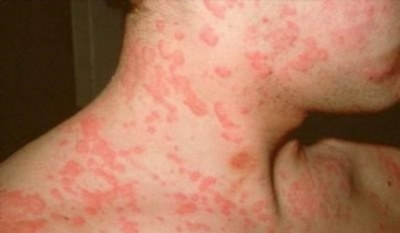 Аллергия на животных: причины и источники аллергенов