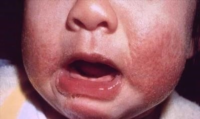 Методы лечения аллергии у ребенка