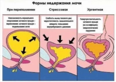 Генетический анализ мочи – поиск наследственной предрасположенности к заболеванию