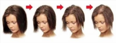 Как вылечить андрогенное выпадение волос у женщин