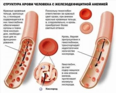 Что такое анемия?