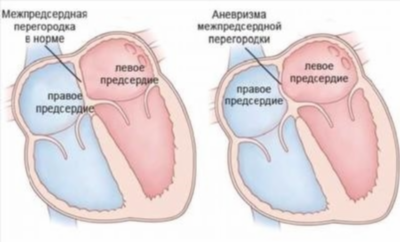 Симптомы при аневризме МПП