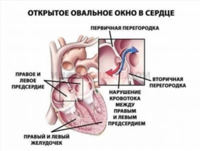 Диагностика аневризмы межпредсердной перегородки