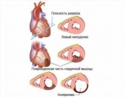 Симптомы аневризмы межпредсердной перегородки