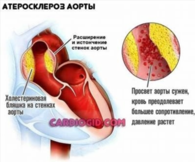 В чем отличие аневризмы сердца от аневризмы легких