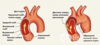 Диагностика аневризмы сердца