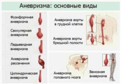 Осложнения разрыва сосуда