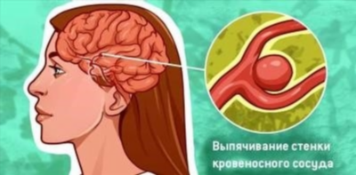 Симптомы разорвавшейся аневризмы головного мозга