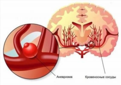 Симптомы церебральной аневризмы