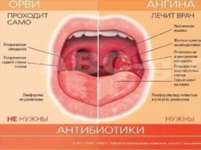 Клиническая картина и симптомы бактериального тонзиллита: заразен или нет